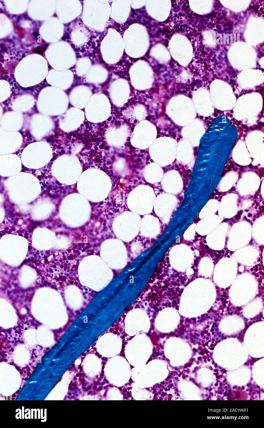 Osteoporosis. Light micrograph of a section through bone tissue in osteoporosis. Osteoporosis