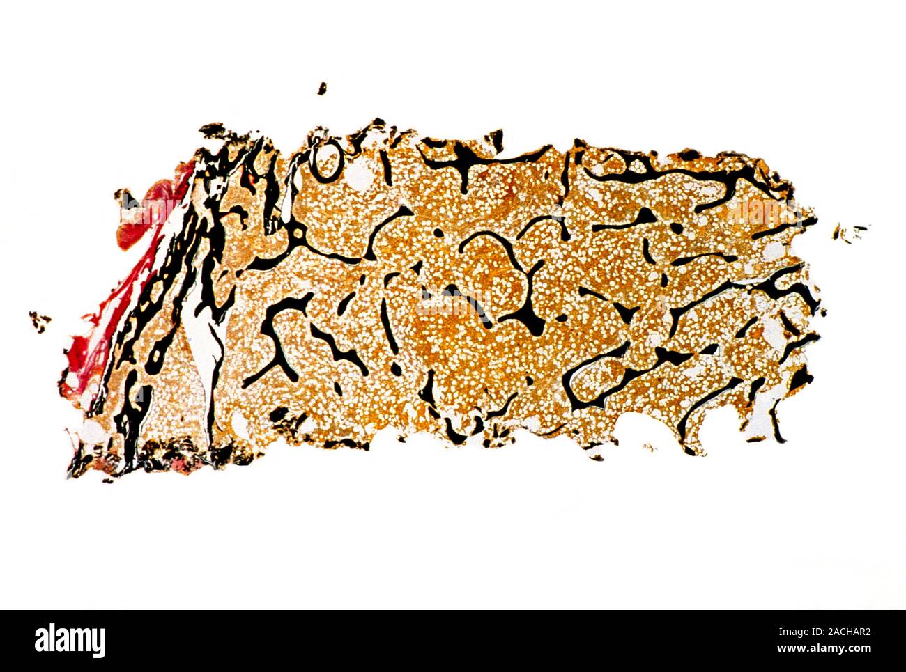 Osteoporosis. Light micrograph of a section through bone tissue in