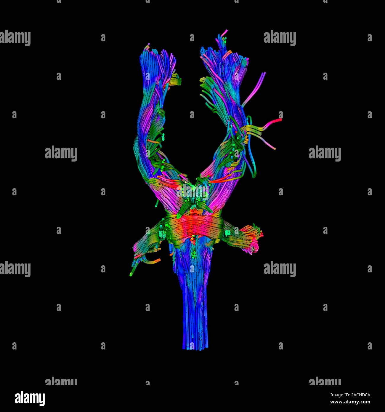 White matter fibres. Coloured 3D diffusion tensor imaging (DTI) scan of ...