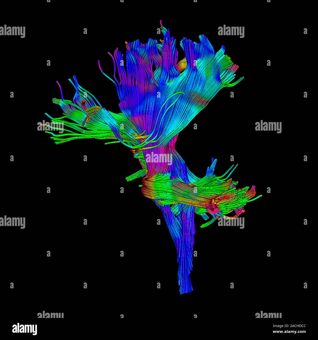 White matter fibres. Coloured 3D diffusion tensor imaging (DTI) scan of ...