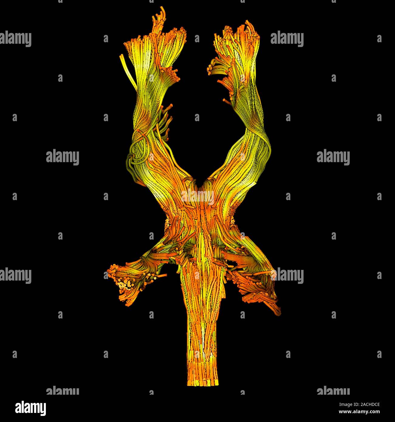 White matter fibres. Coloured 3D diffusion tensor imaging (DTI) scan of ...