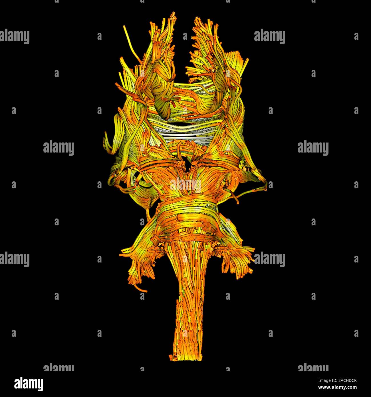 White matter fibres. Coloured 3D diffusion tensor imaging (DTI) scan of ...