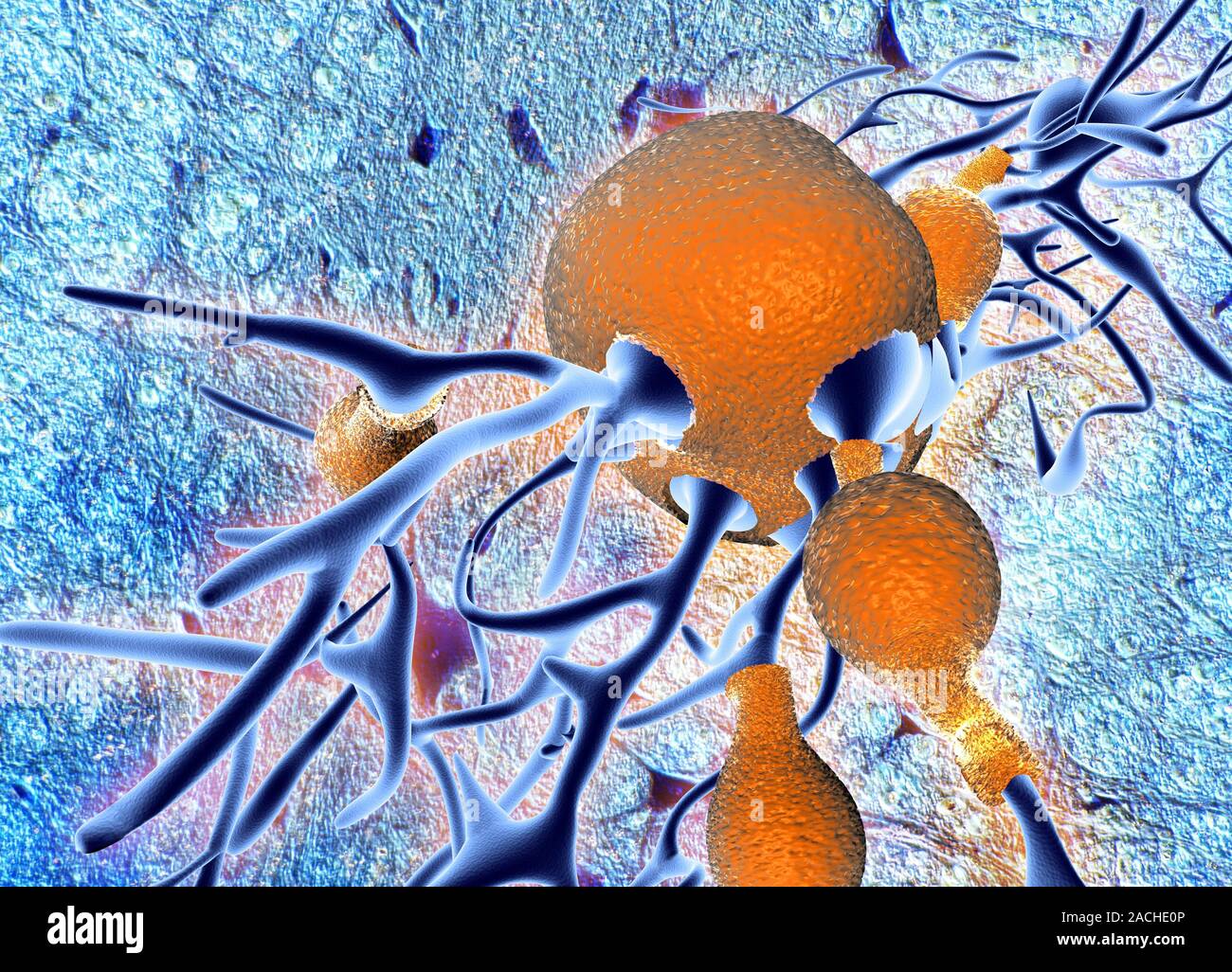 3D computer artwork depicting senile amyloid plaque (brown) in the