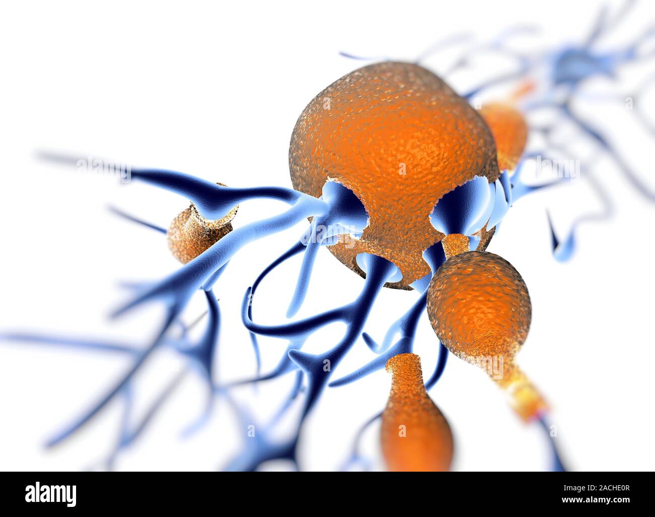 3D computer artwork depicting senile amyloid plaque (brown) in the