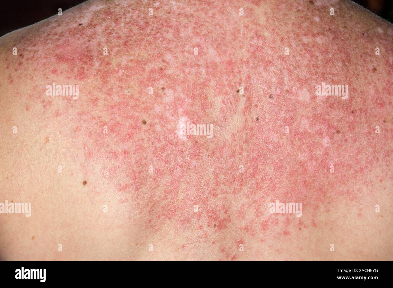 Lupus (SLE) rash on the skin of the back in a 53 year old female