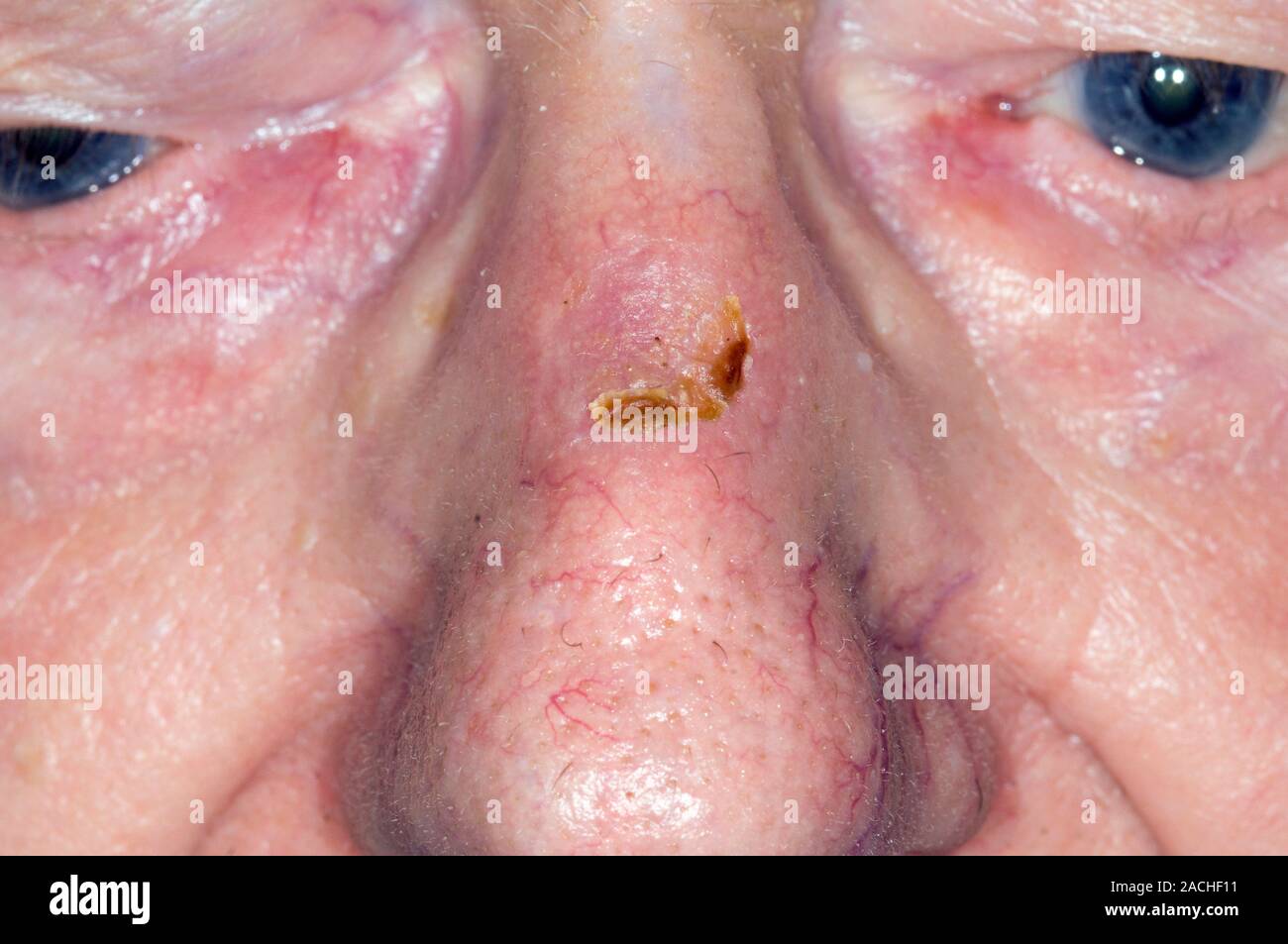 Closeup of the scar on the nose of an 86 year old male patient after removal (excision) of