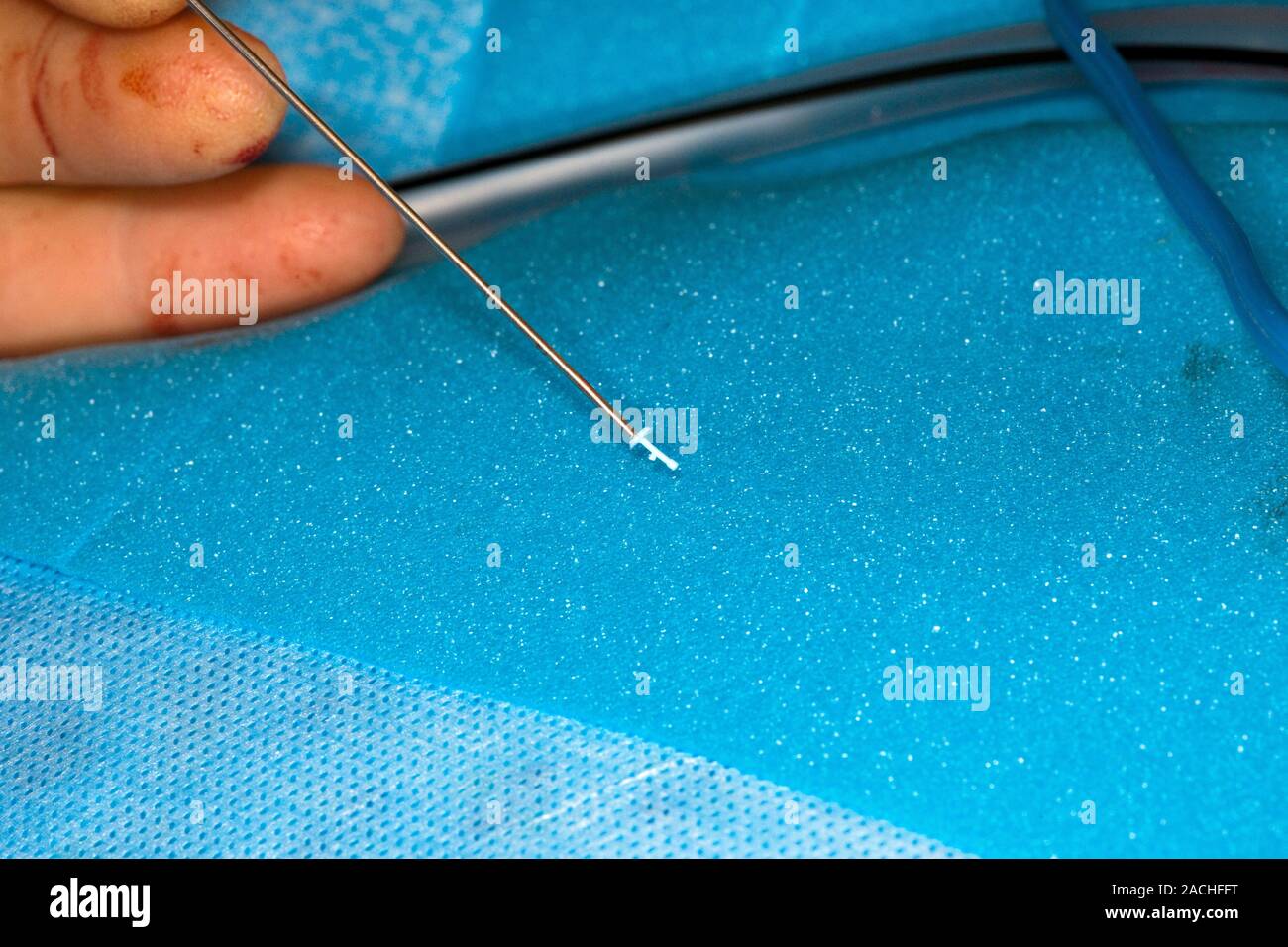 Ear surgery. Prosthetic middle ear bone prior to insertion during