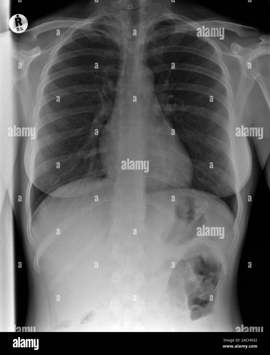 Swallowed toothbrush. Xray of the abdomen of a female patient who has