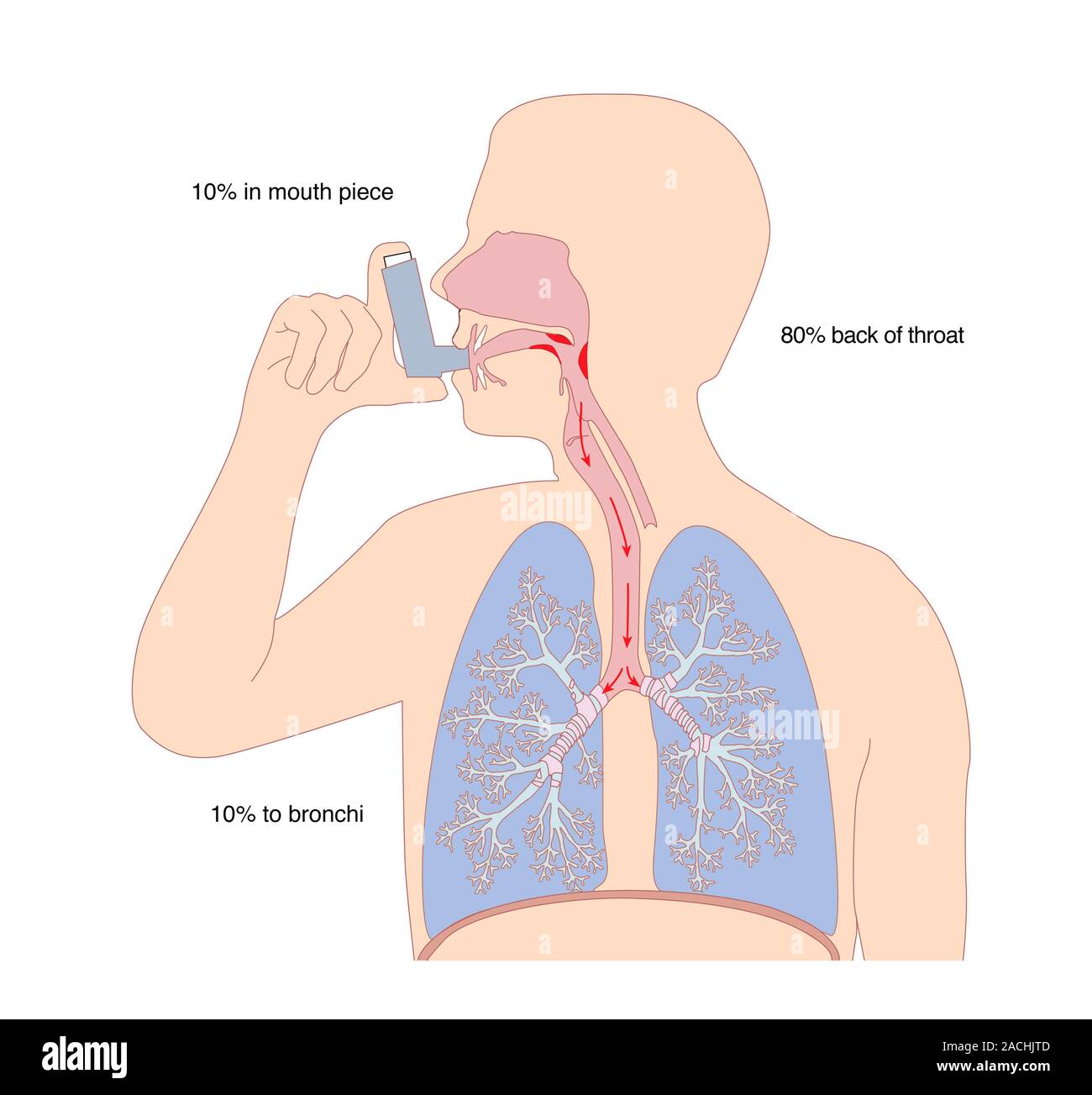 Asthma inhale use. Artwork showing the passage of the bronchodilator ...