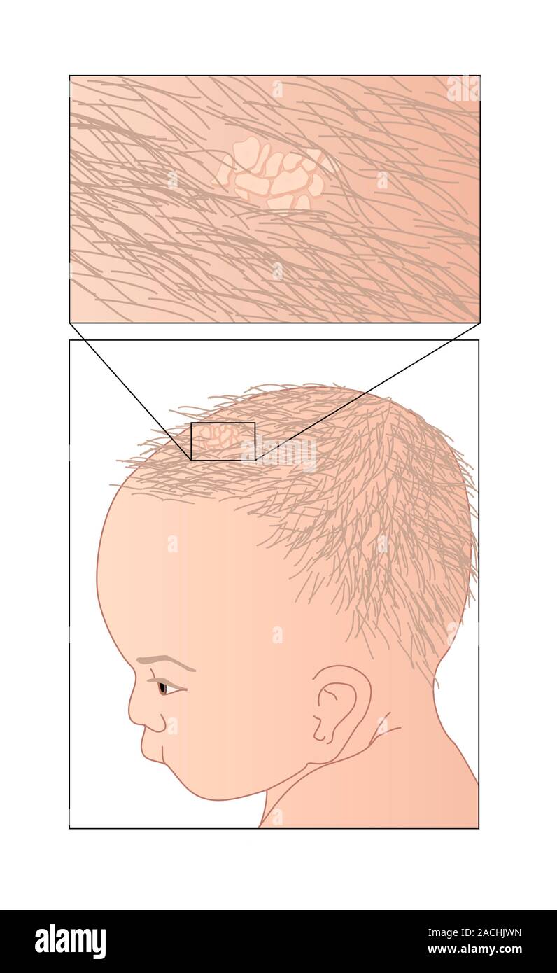 Cradle cap. Artwork showing cradle cap (crusta lactea) on a baby's