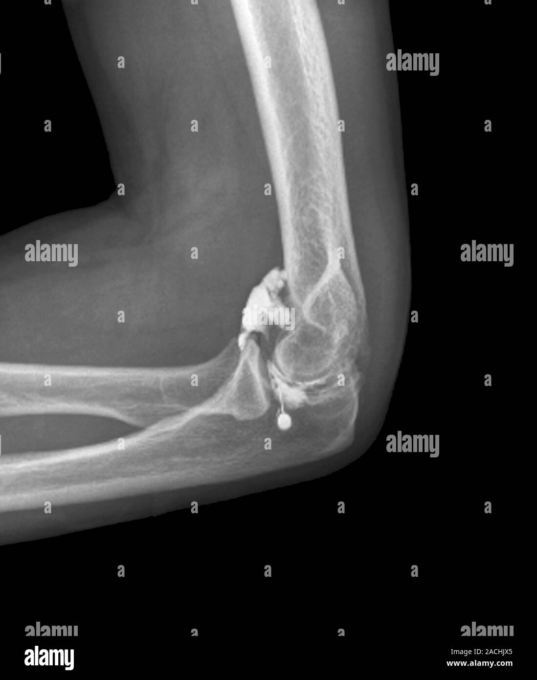Elbow arthritis pain treatment. Lateral Xray showing a needle (bright