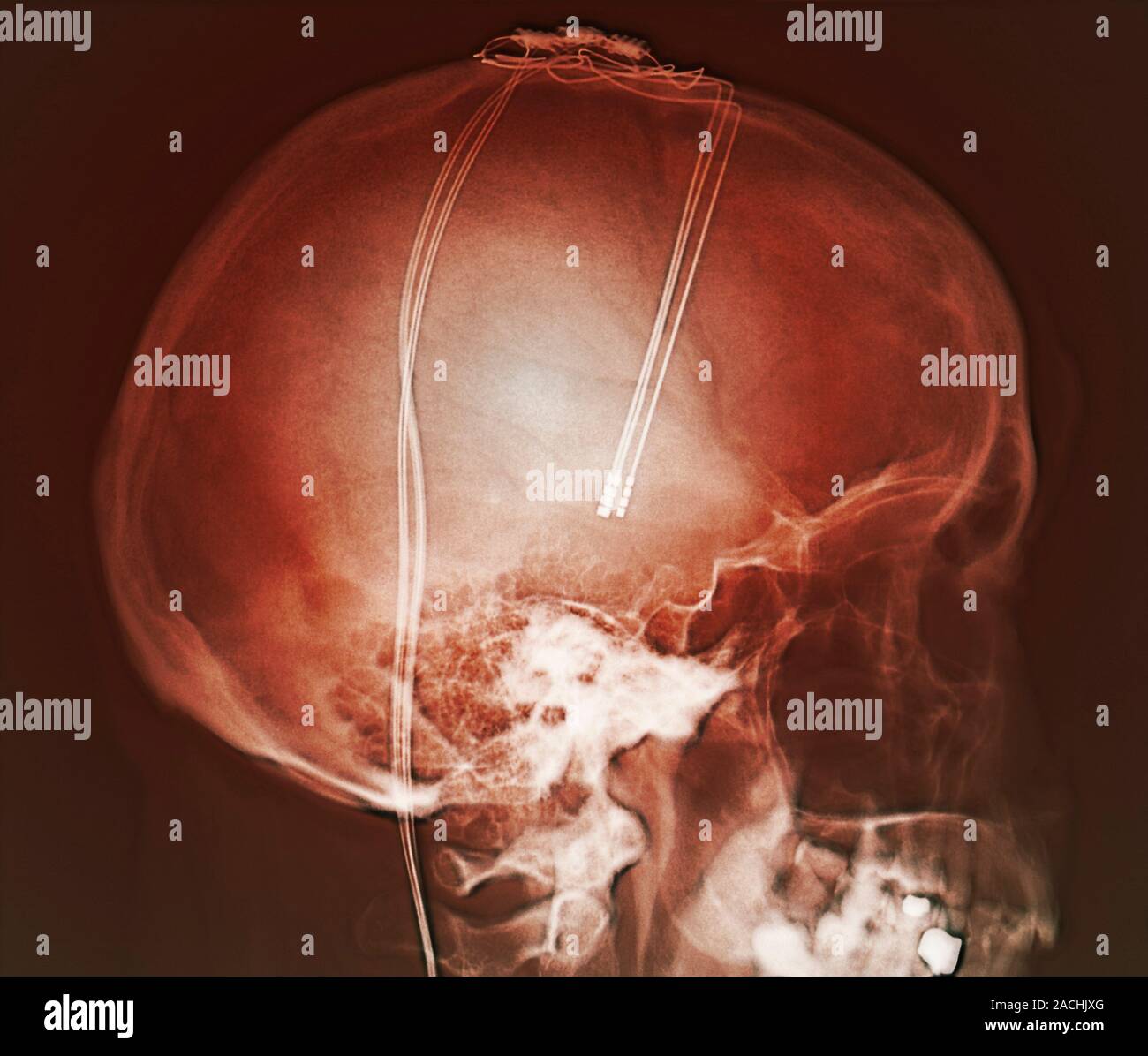 Deep brain stimulation (DBS) electrodes. Coloured lateral X-ray of ...