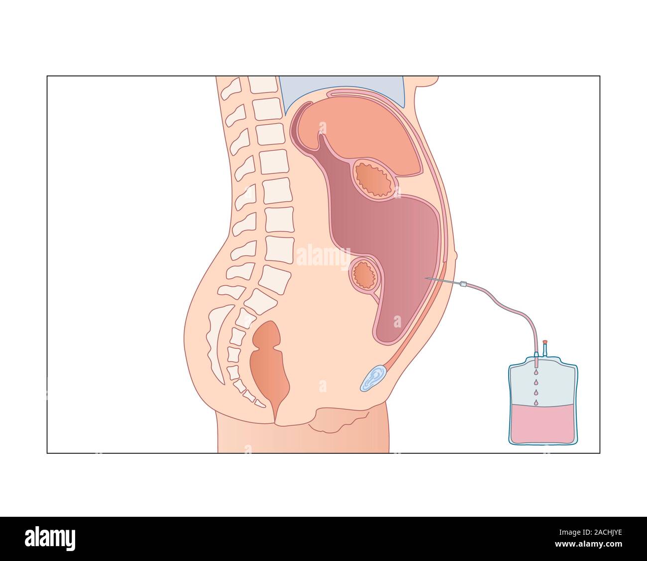 Draining ascites. Artwork of a section through the abdomen showing