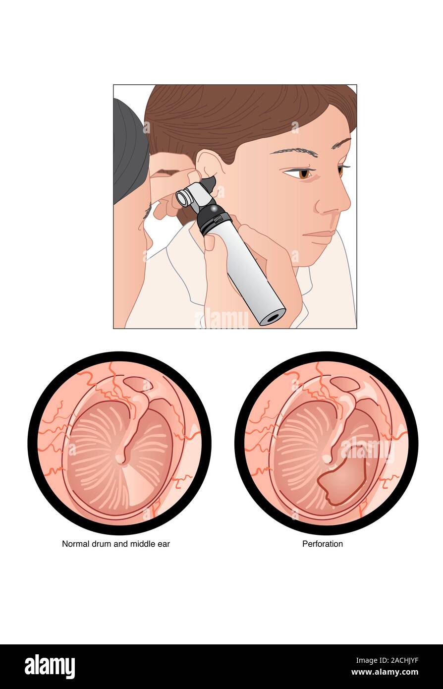 Perforated Ear Perforated eardrum. Artwork of a perforated (torn) eardrum (right), or ...