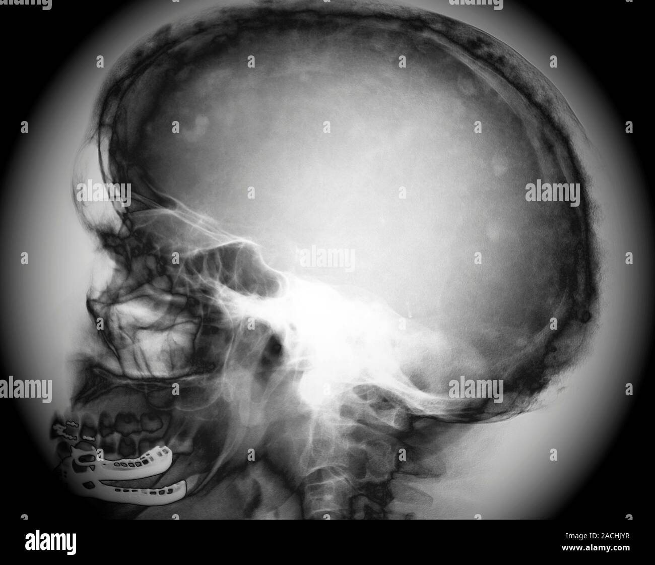 Paget's disease. Lateral Xray of the skull of a 62yearold patient