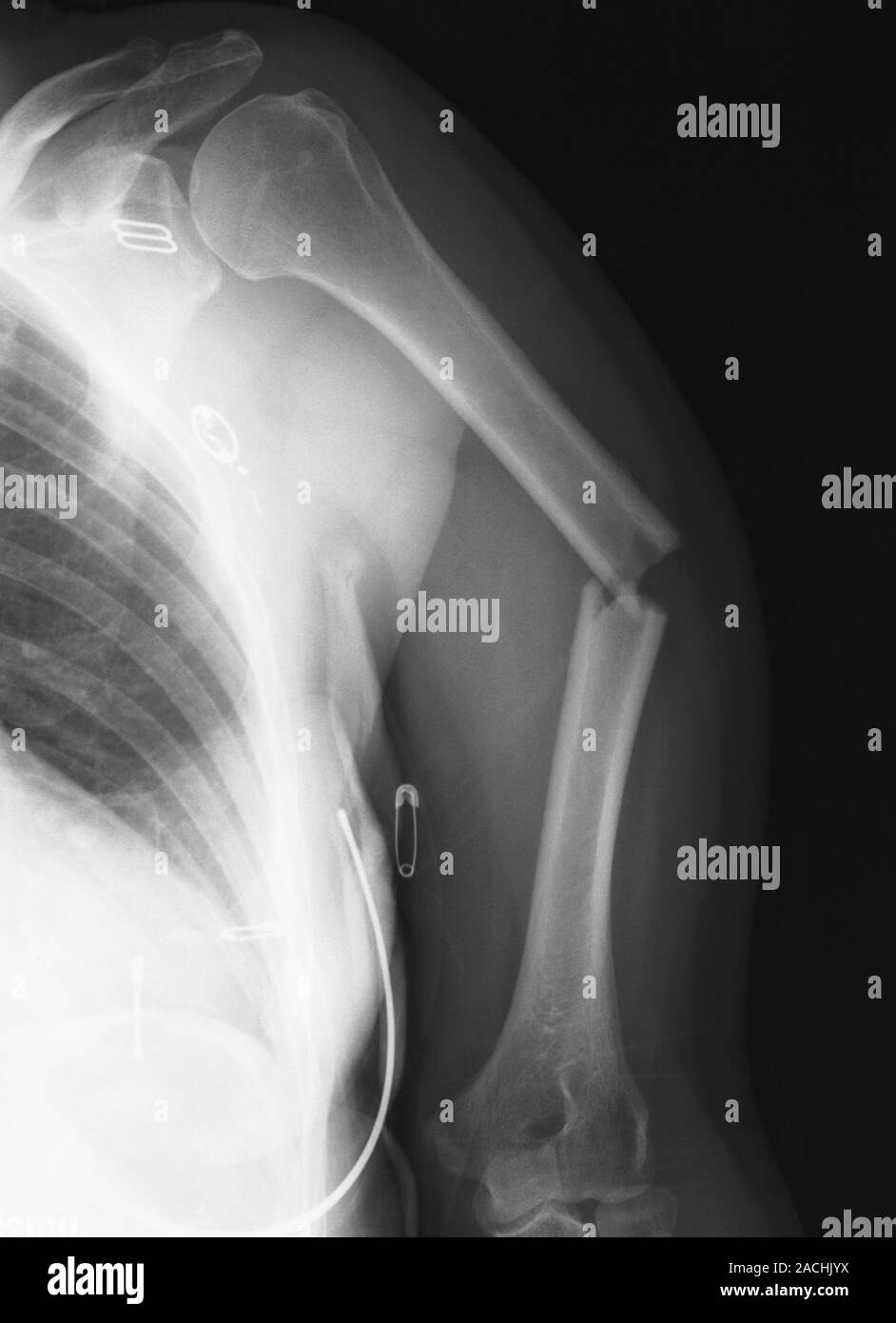 Broken arm bone. Frontal Xray of the fractured left humerus (upper arm