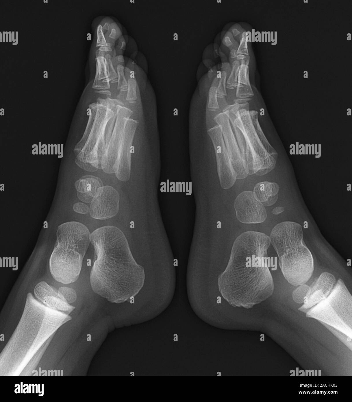 Childhood bone development. Xray of a 4yearold child's feet, showing