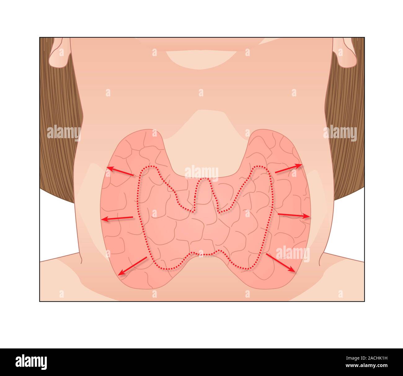 Goitre. Artwork of an enlarged thyroid gland (goitre). The normal size ...