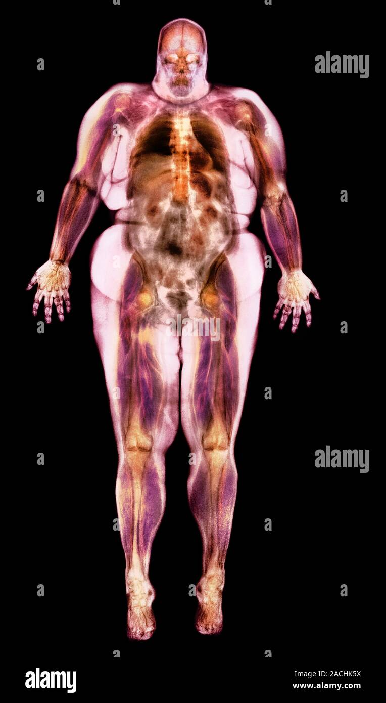 Obese Magnet Color Obese woman, coloured magnetic resonance (MRI) scan. This image is a ...