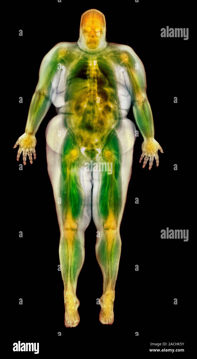Obese Magnet Color Obese woman, coloured magnetic resonance (MRI) scan. This image is a ...
