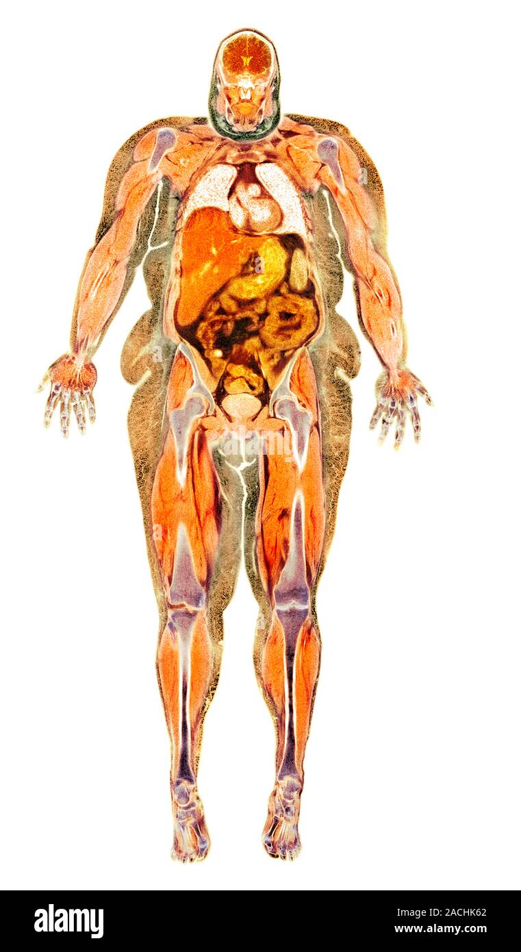 Obese Magnet Color Obese woman, coloured magnetic resonance (MRI) scan. This coronal scan ...
