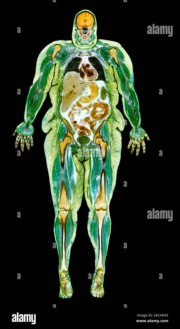 Obese Magnet Color Obese woman, coloured magnetic resonance (MRI) scan. This coronal scan ...