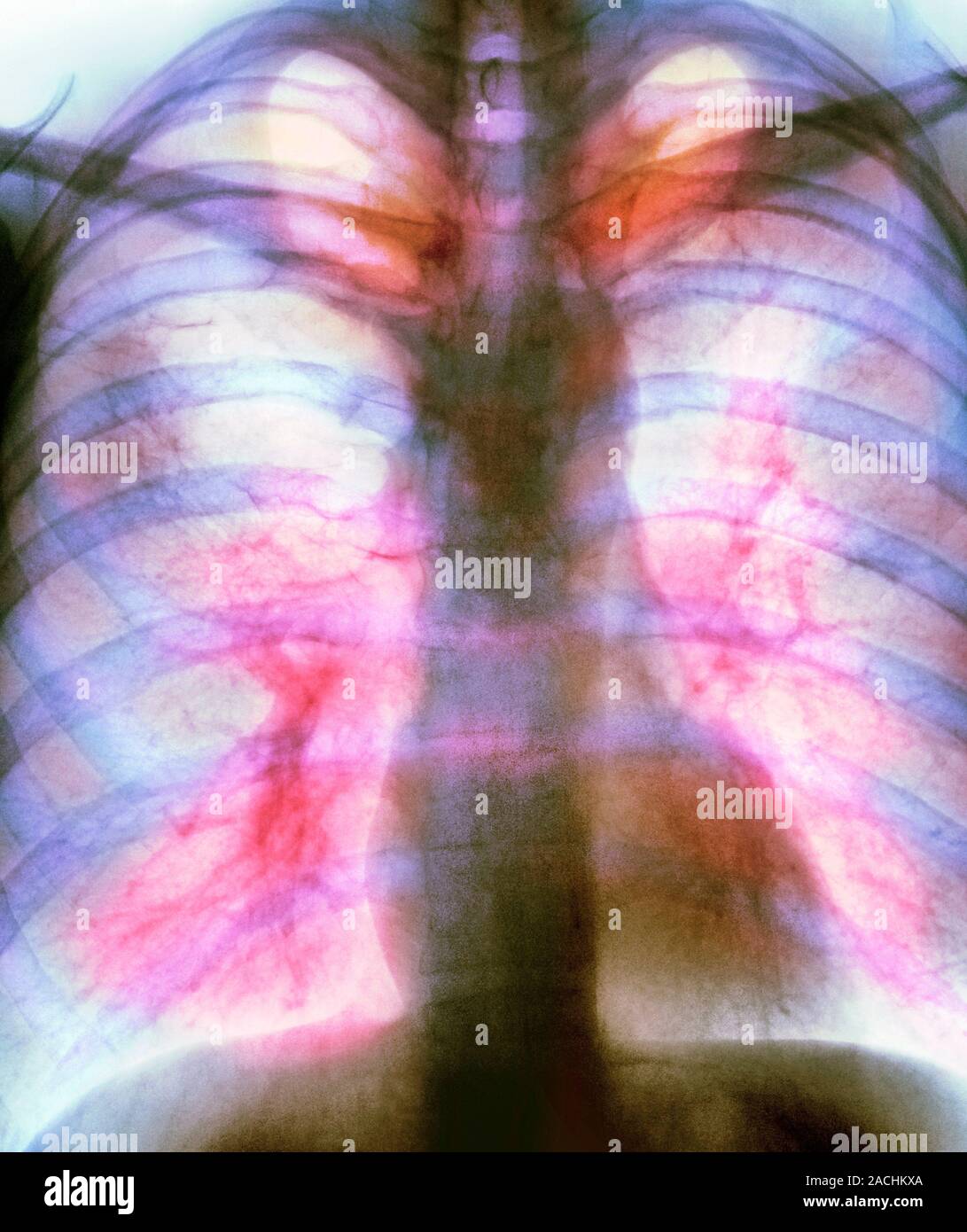 Coloured Xray (front view) of the chest in a 41 year old male patient