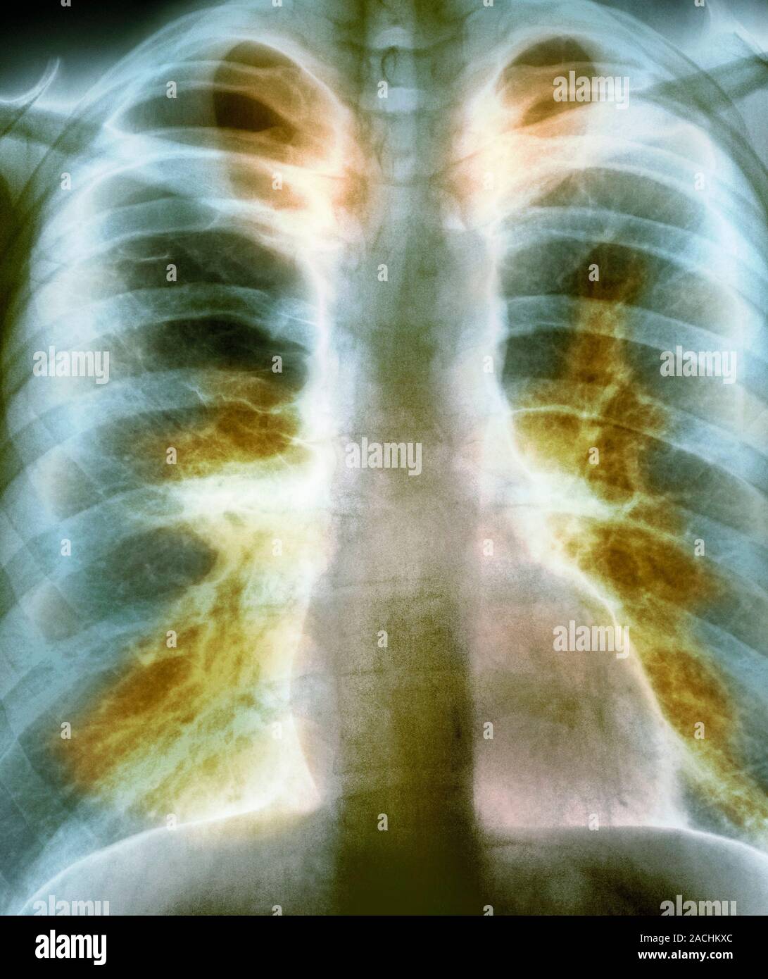 Coloured X-ray (front view) of the chest in a 41 year old male patient ...