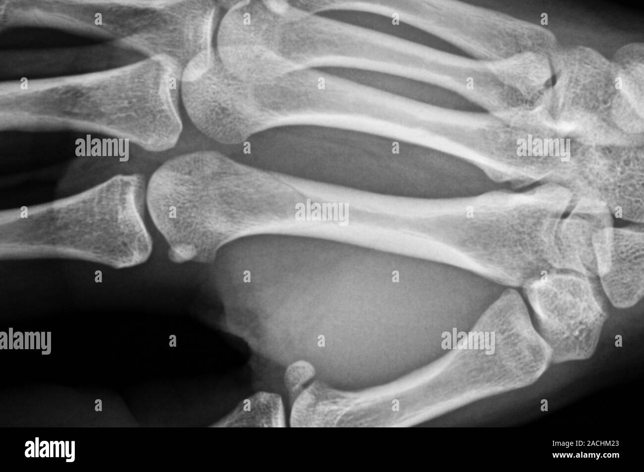 Xray (side view) of the hand in a 19 year old male patient showing a