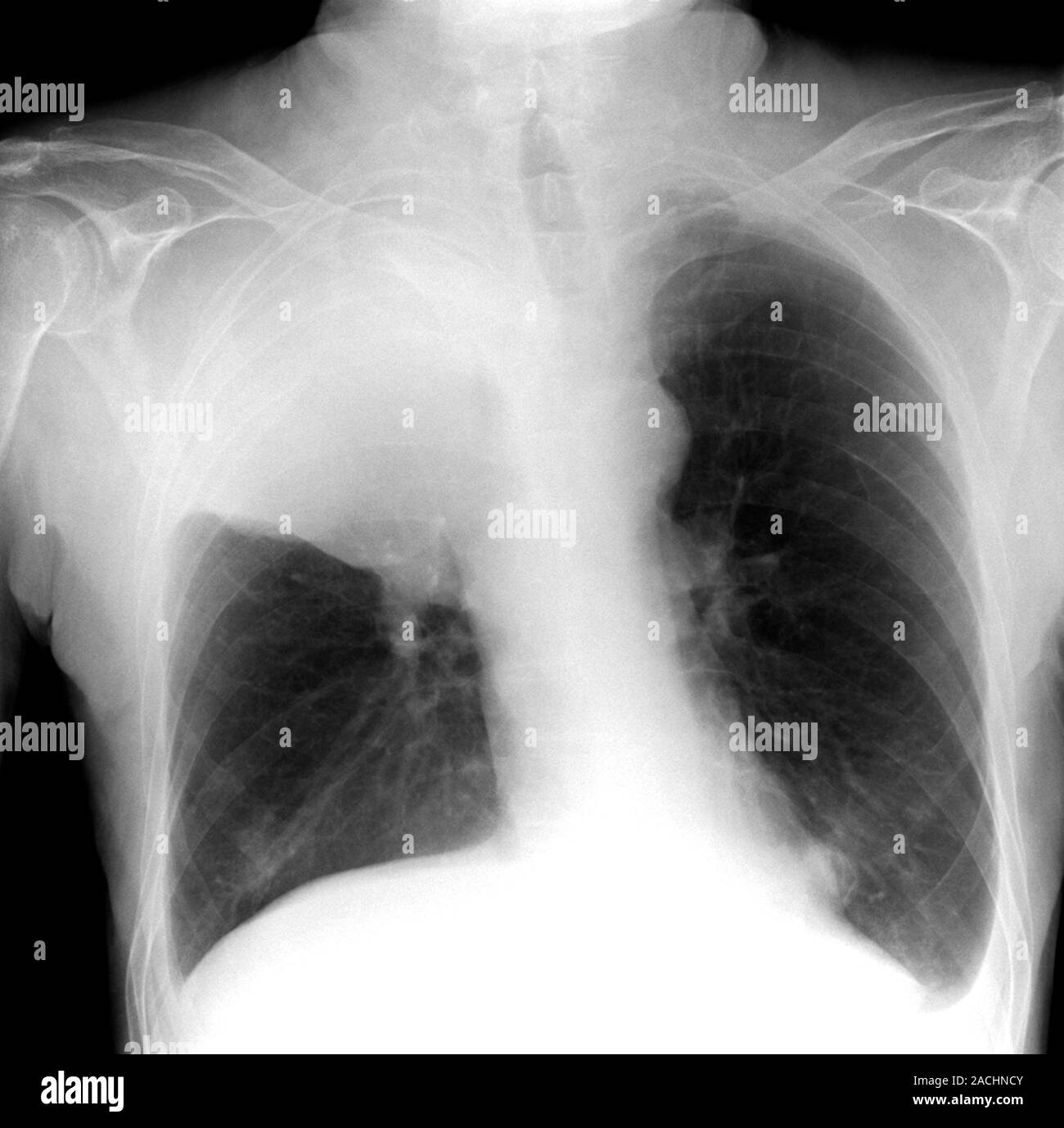lung-cancer-frontal-x-ray-showing-a-bronchial-carcinoma-white-upper