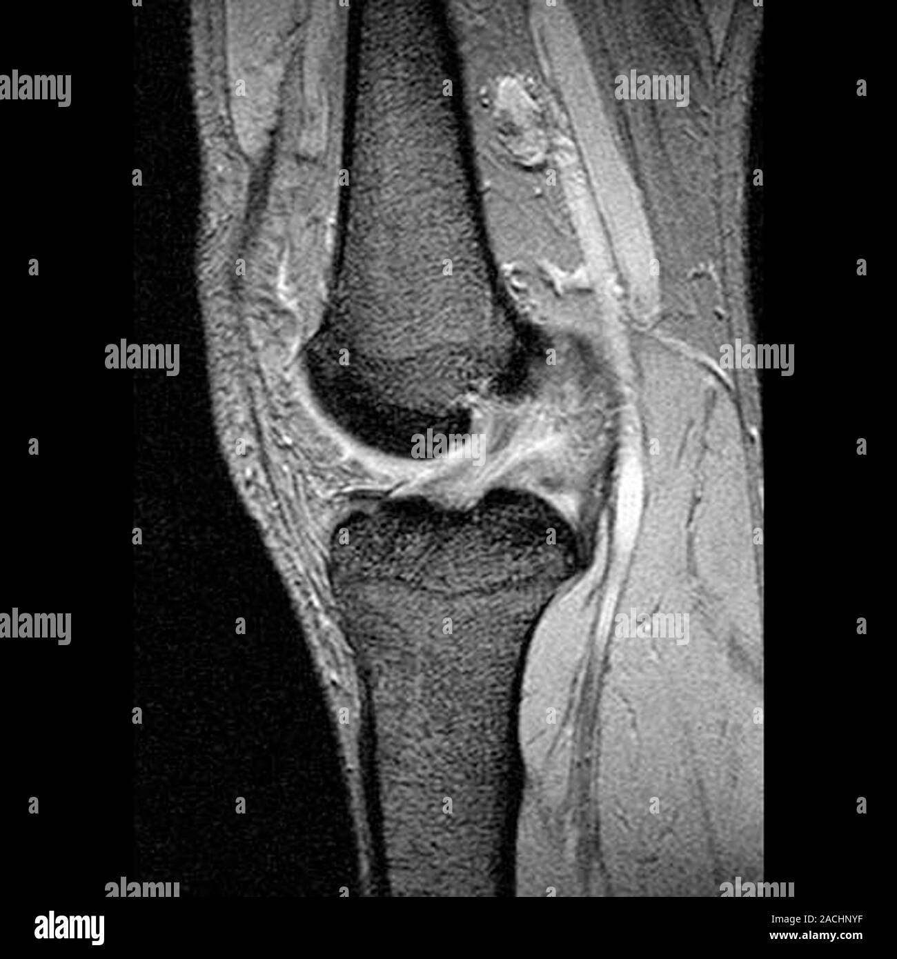 Anterior cruciate ligament tear. Computer tomography (CT) scan of the ...