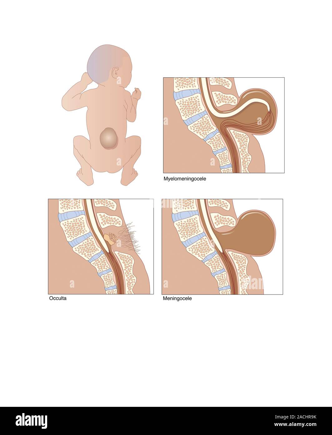 Spina bifida. Artwork showing the three main types of the birth defect ...
