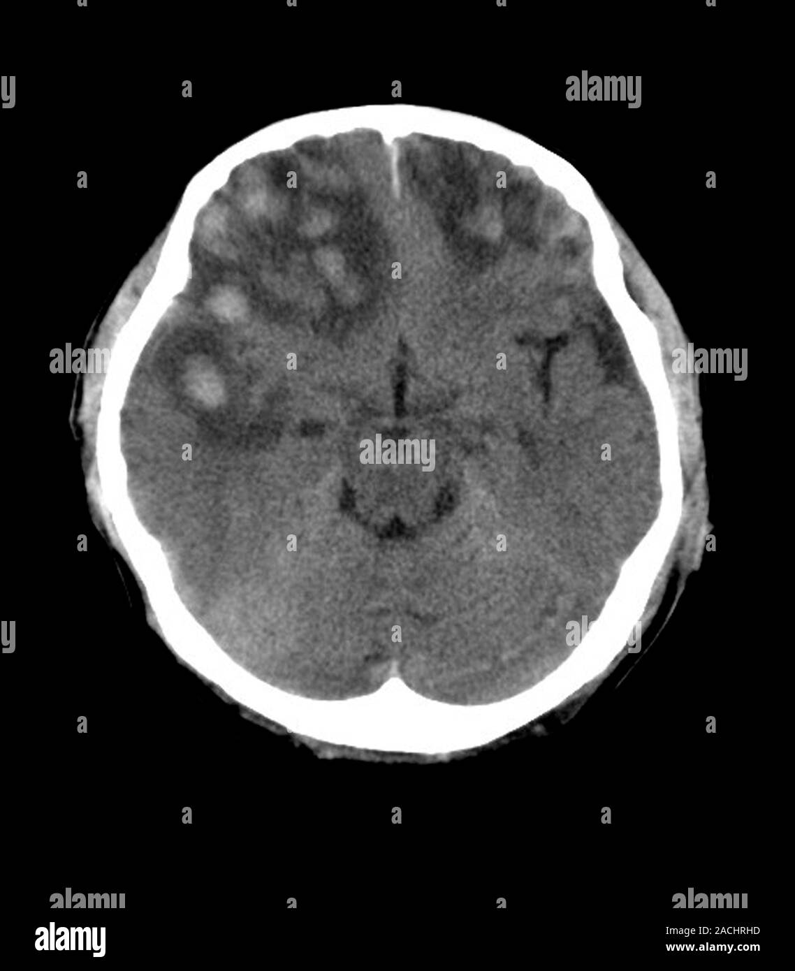 Brain haemorrhage. resonance imaging (MRI) scan of an axial