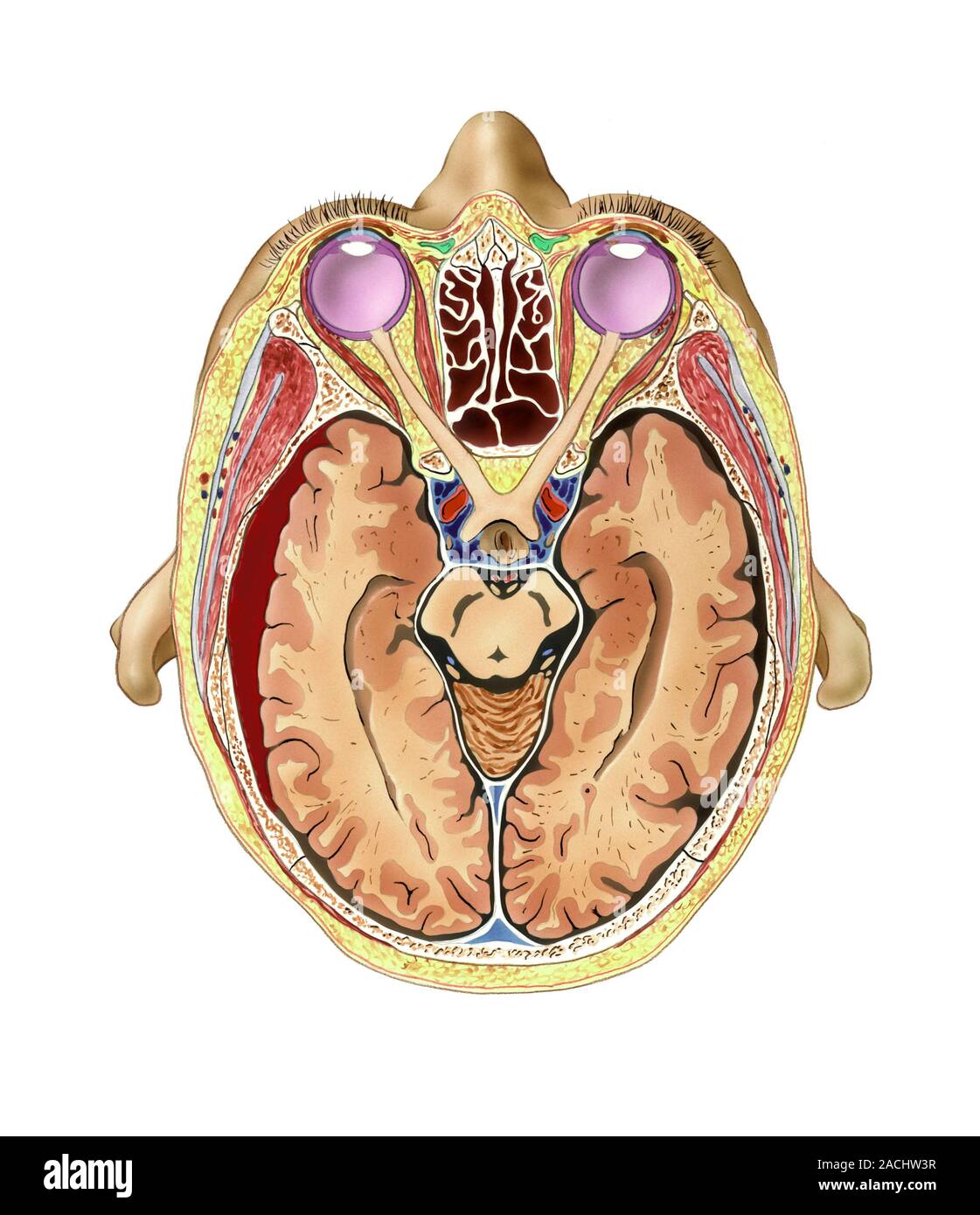 Brain haemorrhage. Computer artwork of a transverse section through the ...