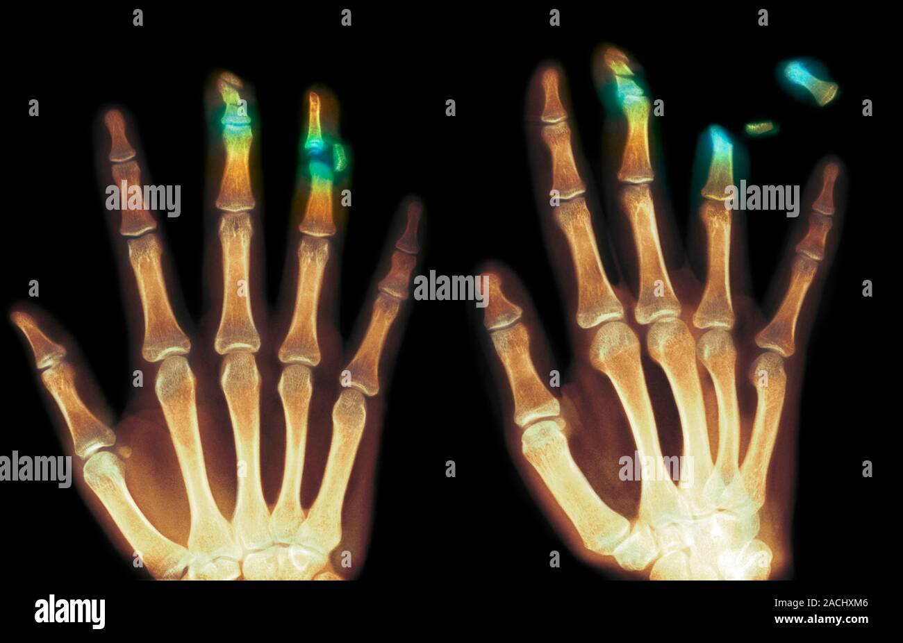 Fingertip laceration injuries, coloured Xrays. Both Xrays show the
