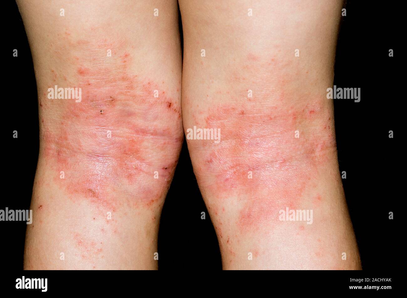 Closeup of a red rash on the back of the knees in a 3 year old male