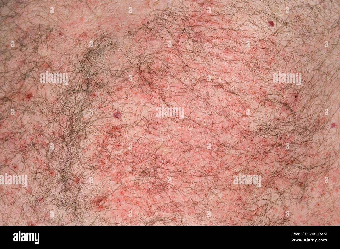 Closeup of a red rash (acute eczema) on the skin of the abdomen in a