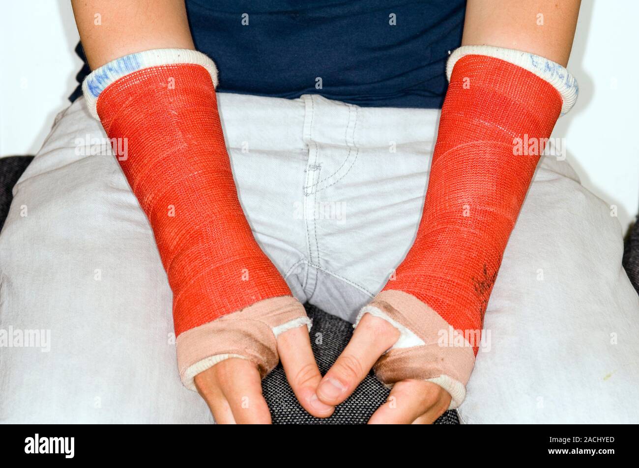 Broken wrists immobilised in plaster casts in a 27 year old male