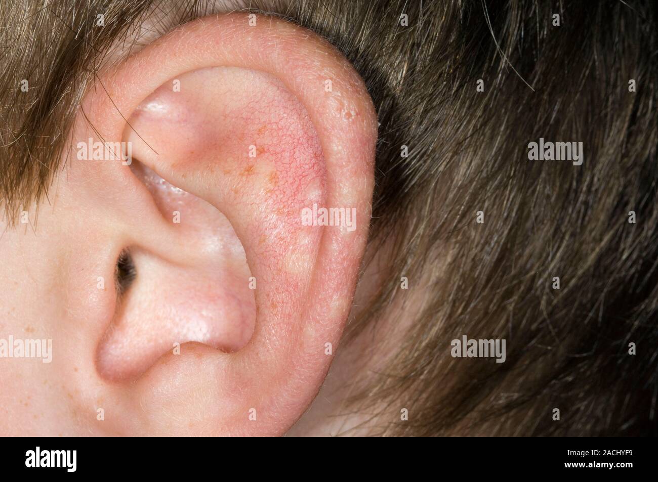 Closeup of pale bumps on the ear pinna in a 7 year old male patient, a
