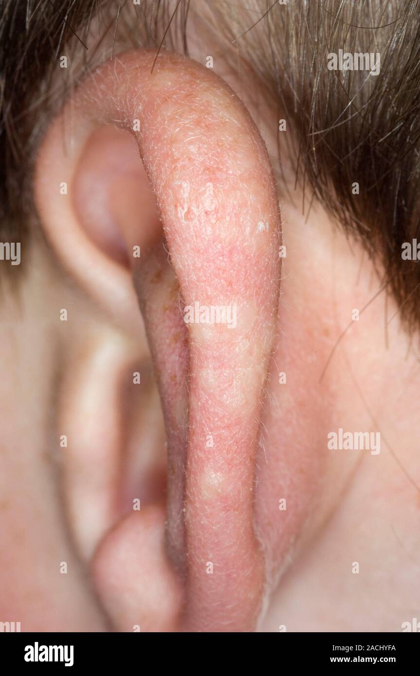 Close Up Of Pale Bumps On The Ear Pinna In A 7 Year Old Male Patient A Condition Known As Juvenile Spring Eruption This Skin Condition Of Unknown Ca Stock Photo Alamy