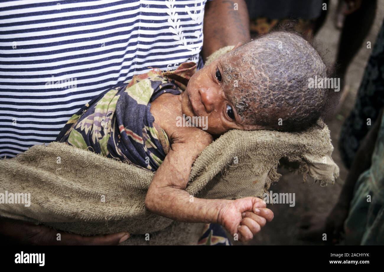 Fungal skin infection. Young infant with an extreme, severe case of ...