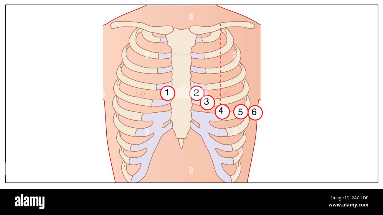 Placing of electrodes for electrocardiogram (ECG), artwork. This