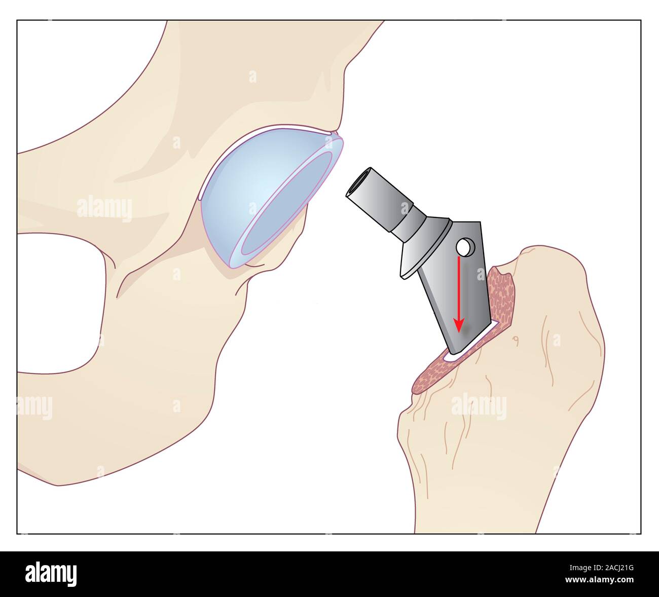 Hip Replacement Artwork Showing A Prosthetic Shaft In A Femur Thigh