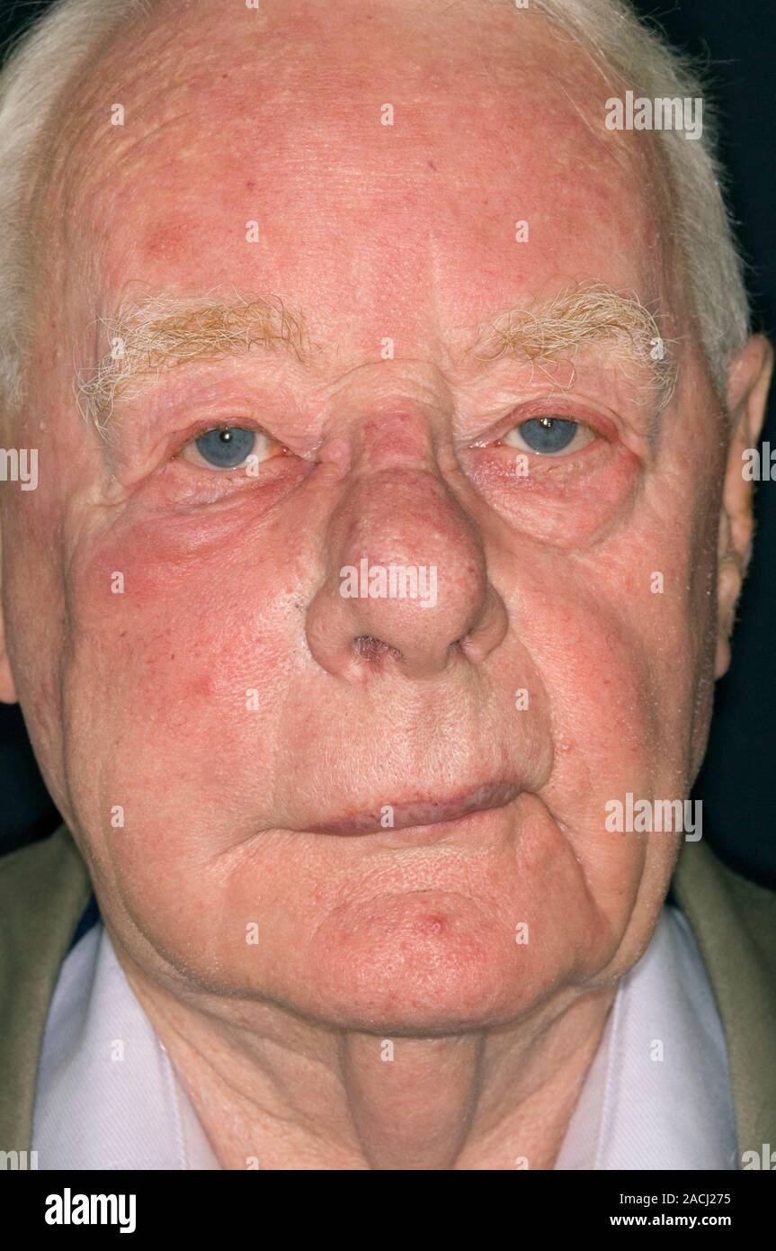 Reddened Skin Of The Swollen Face In An 87 Year Old Male Patient Due To 