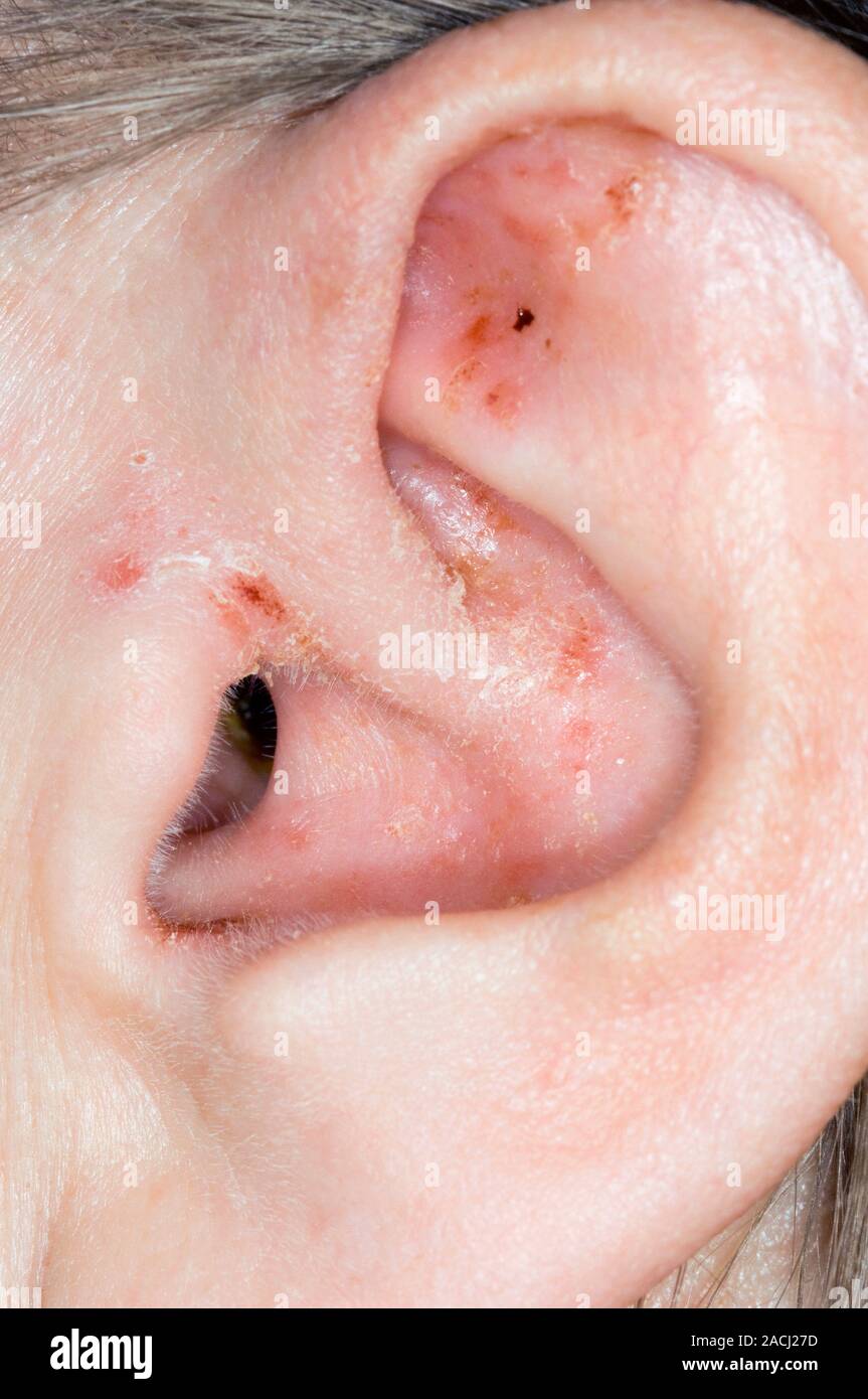 Closeup of red patches of scaling skin on the ear in a 52 year old