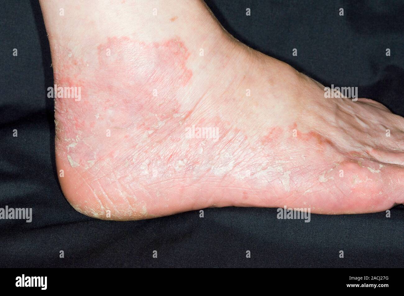 Close-up of red patches of scaling skin on the foot in a 76 year old