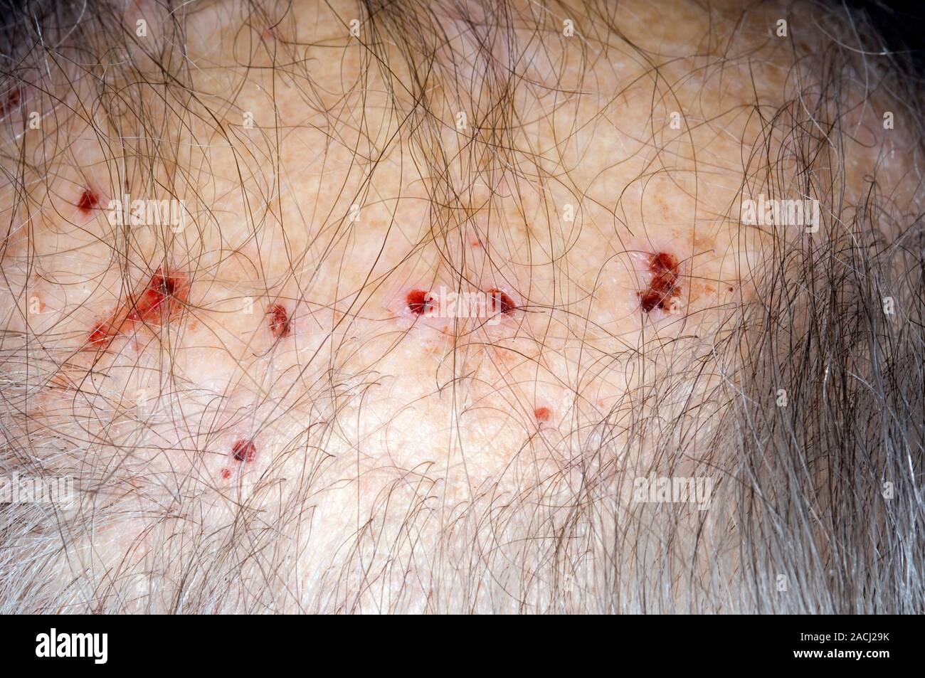 gabapentin for renal itch