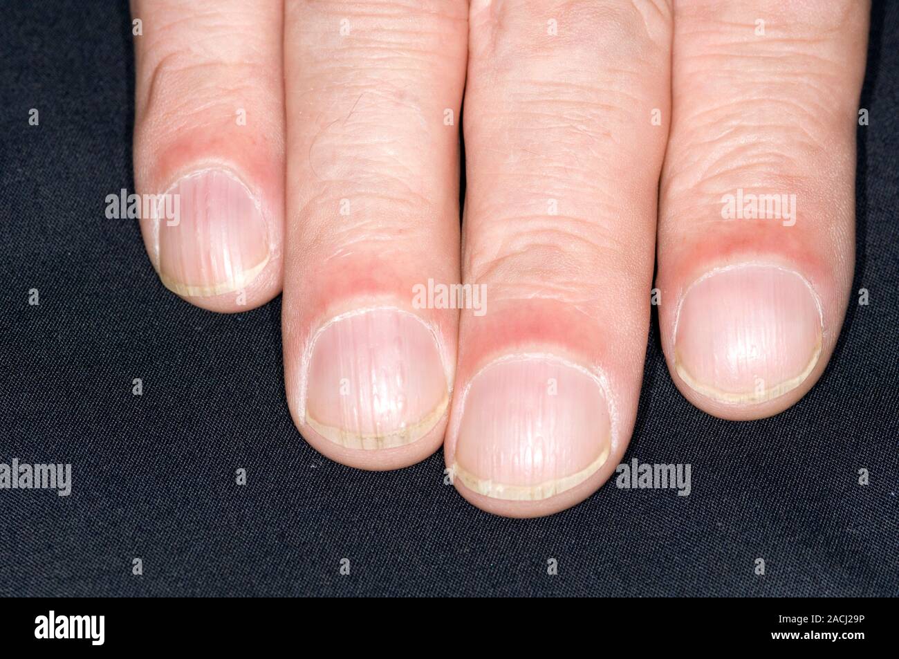 Clubbing of the fingers in a 64 year old male patient with idiopathic ...