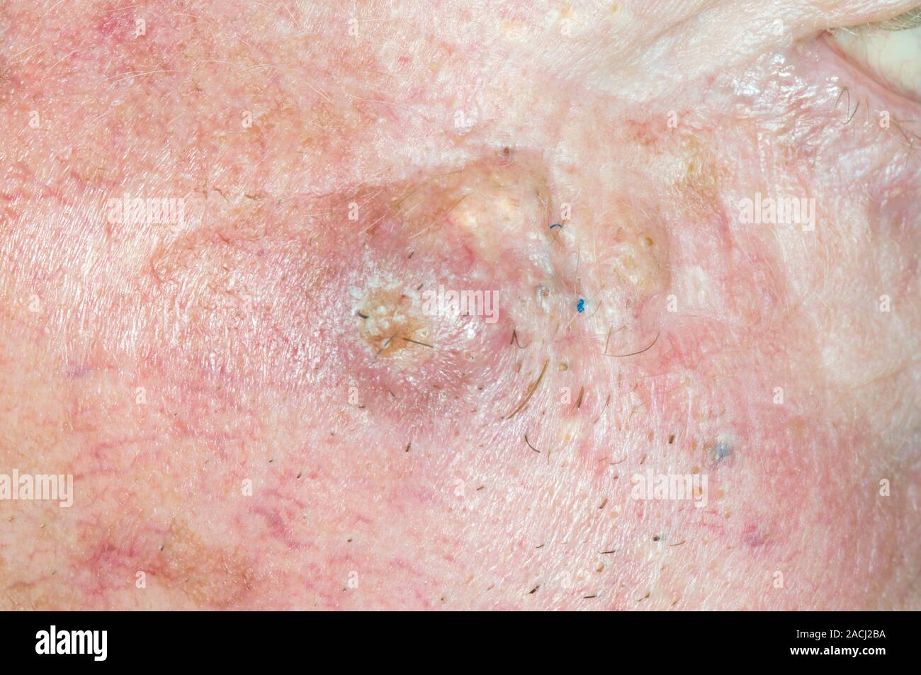 Closeup of basal cell carcinoma (cancer) on the skin of the face in a