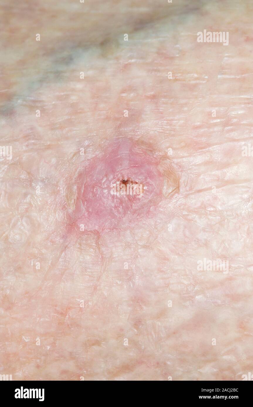 Close-up of basal cell carcinoma (cancer) on the skin in a 95 year old  female patient. Also known as rodent ulcer, this skin cancer is thought to  be c Stock Photo -